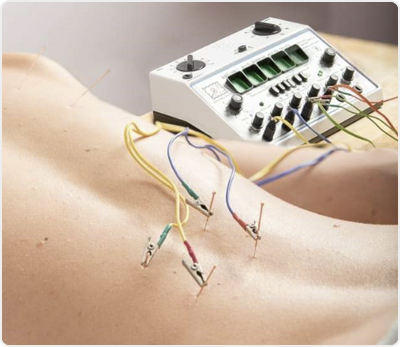 Dry Needling with Electro Therapy